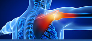 4 Questions to Ask About Arthroscopic Rotator Cuff Near Me Gallatin, TN and Nashville, TN