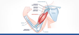 Bicep Tenodesis Recovery Near Me in Gallatin and Nashville TN Bicep Tenodesis Recovery Near Me in Gallatin and Nashville TN